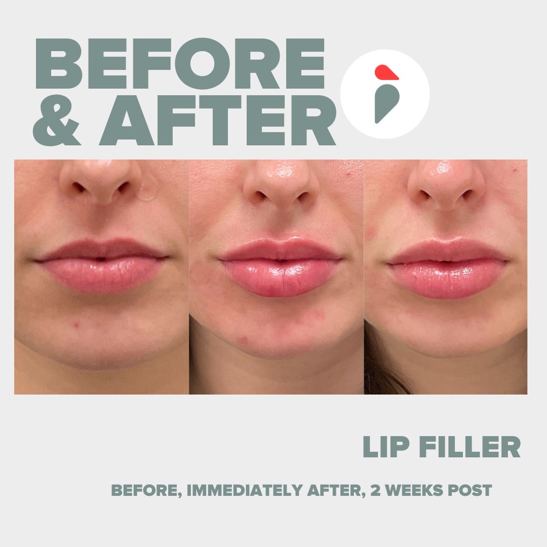 Lip Filler – Nashville patient
