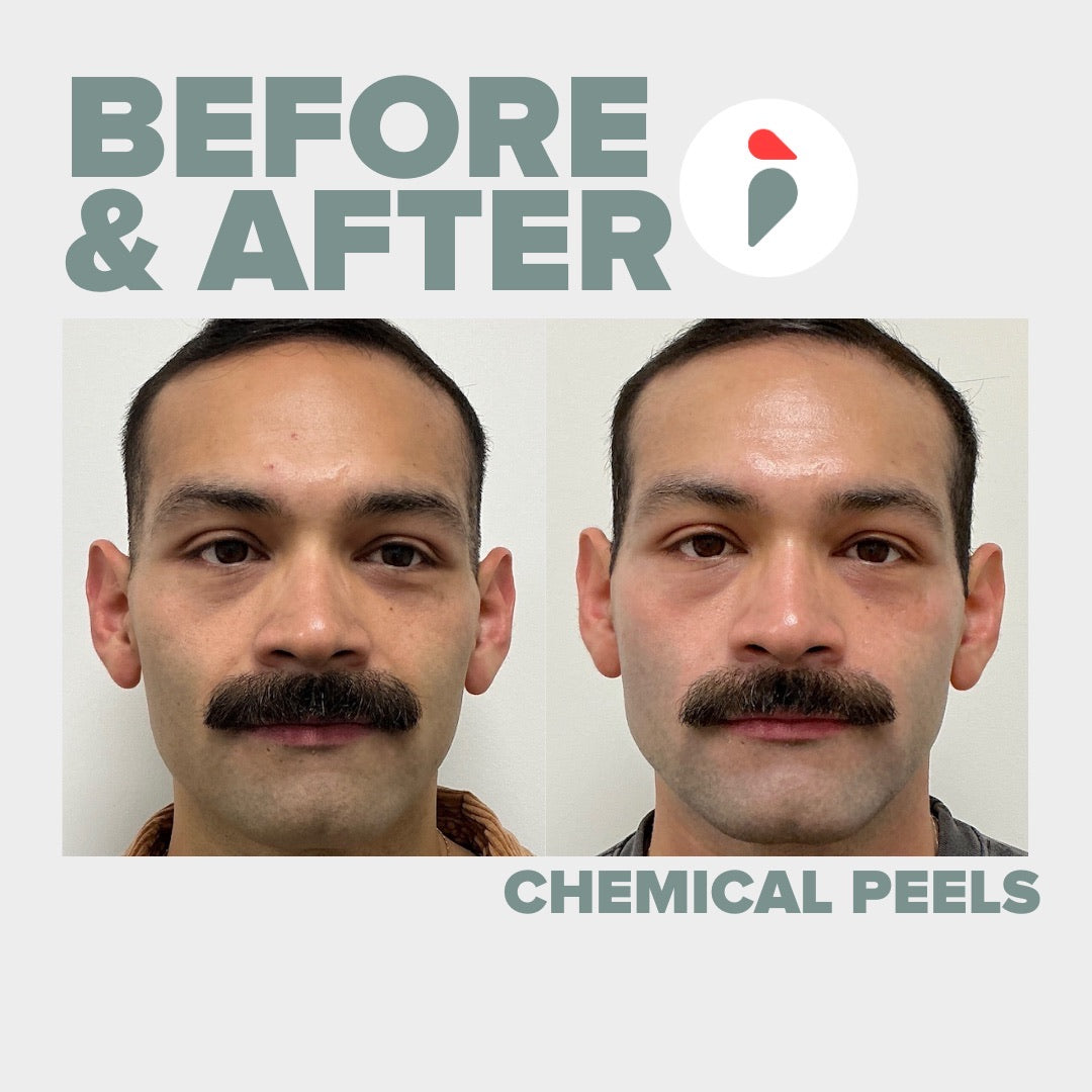 Chemical Peel – Nashville patient