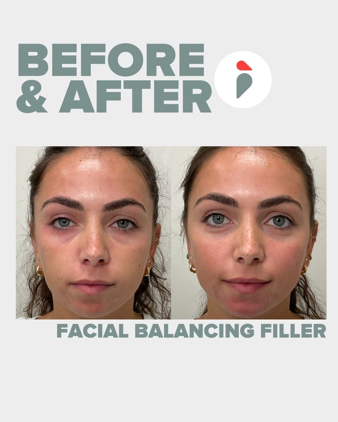 Facial Balancing Filler  – Nashville patient