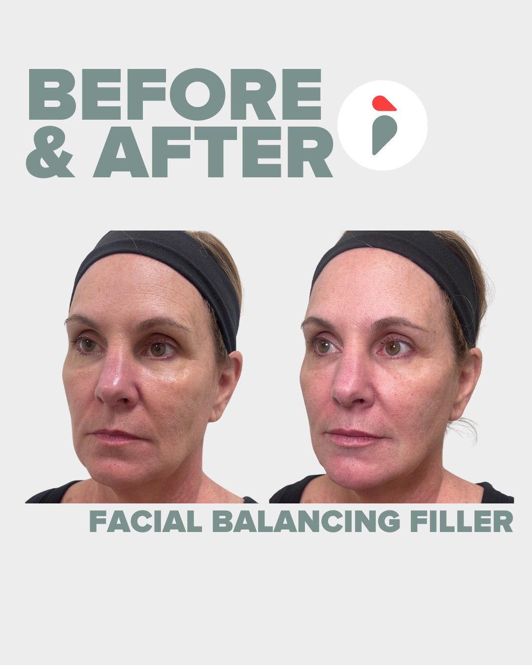 Facial Balancing Filler – Nashville patient