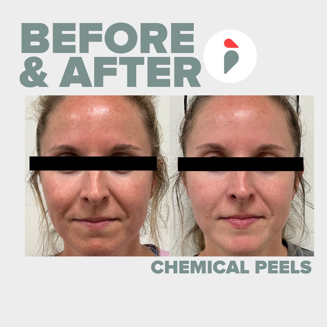 Chemical Peel – Nashville patient