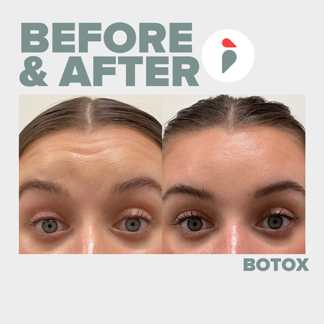 Botox forehead lines – Nashville patient