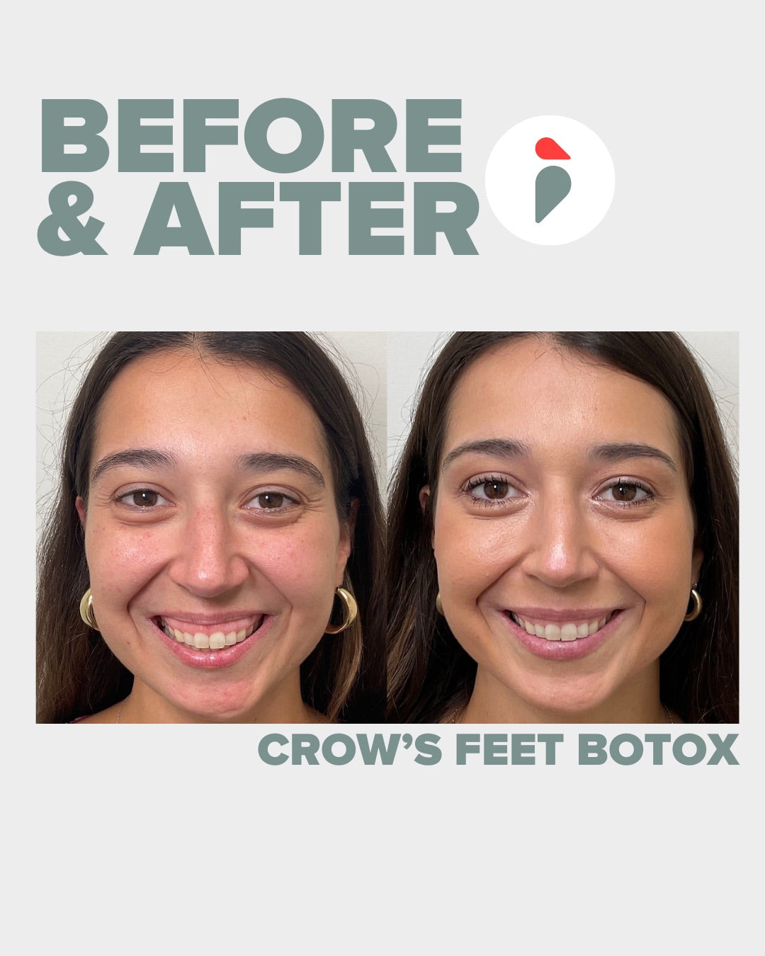 Crow's Feet Botox – Nashville patient