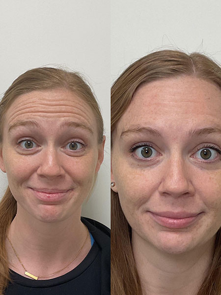 Client's wrinkle-free results after Botox in Nashville, TN