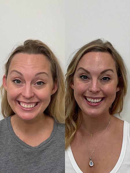 Side-by-side comparison of a client before and after Botox injections in Nashville, TN