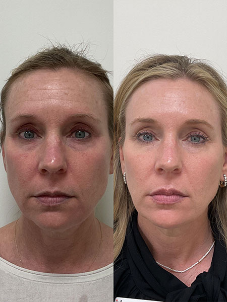 Stunning results of Botox injections in Nashville, TN