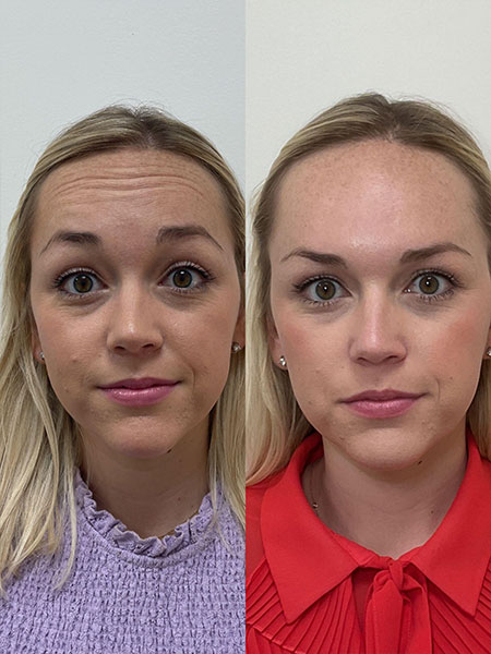 Results of Botox with before and after images of a client in Nashville, TN