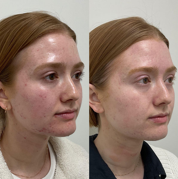 Patient's clear skin results from BBL HERO in Nashville