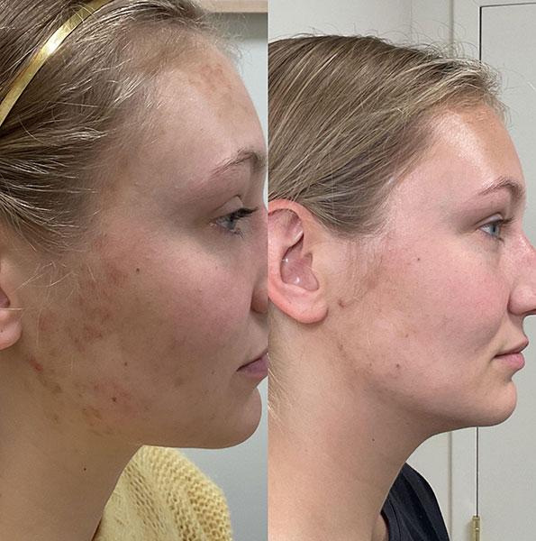 Woman's before & after clear skin results after laser skin resurfacing in Nashville, TN