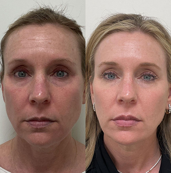 Patient's clear skin results from laser skin resurfacing in Nashville