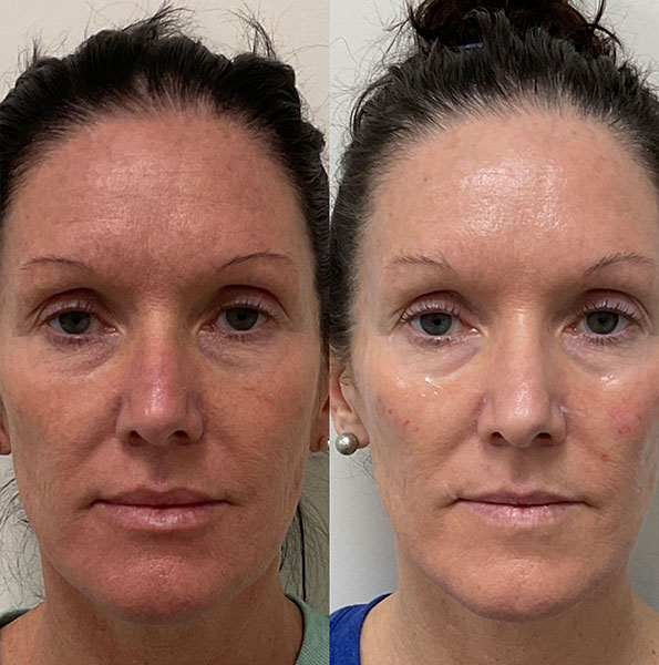 Woman's before & after clear skin results from BBL HERO in Nashville, TN