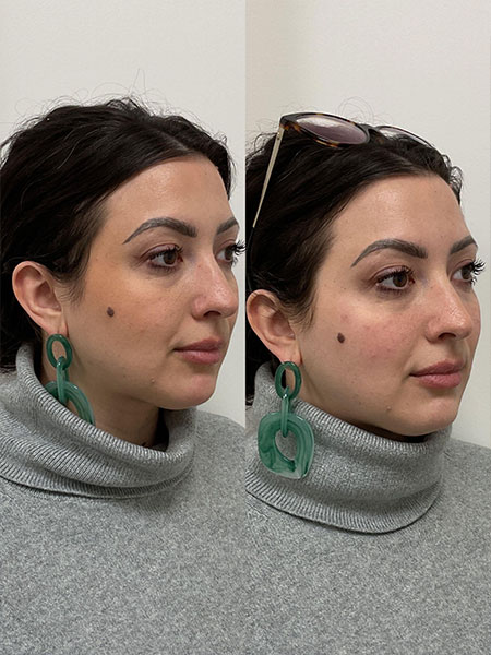 Results from cheek fillers in Nashville, TN