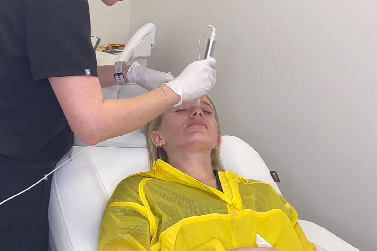 Patient receiving microneedling treatment in Nashville, TN