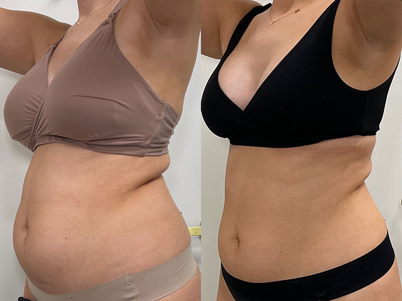 woman before and after electrical muscle stimulation in Nashville