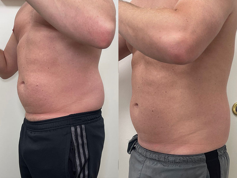 man before and after electrical muscle stimulation in Nashville
